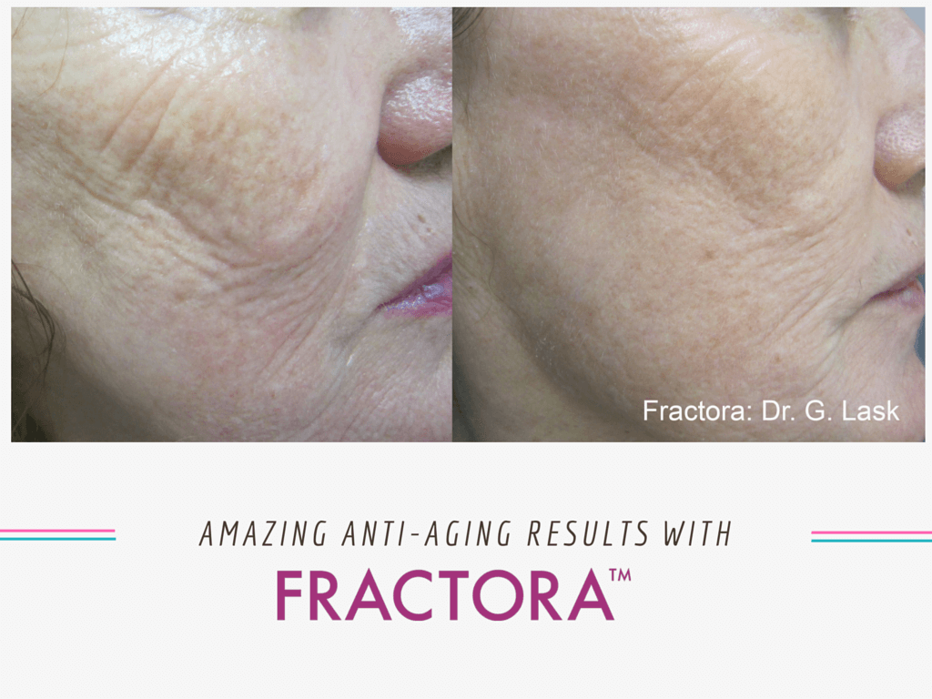 Before & after Fractora