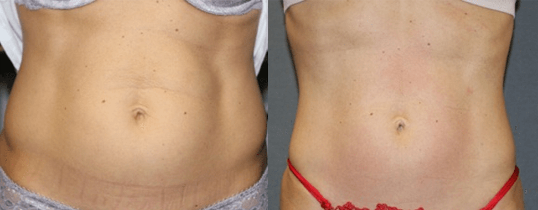 Body FX laser fat reduction