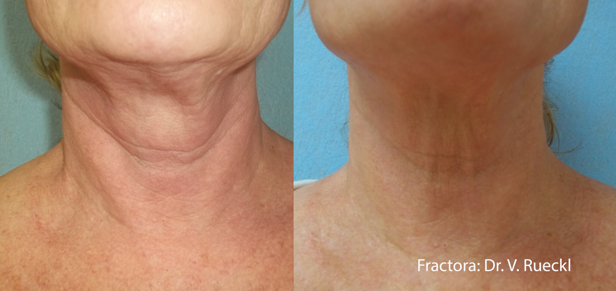 Fractora before/after