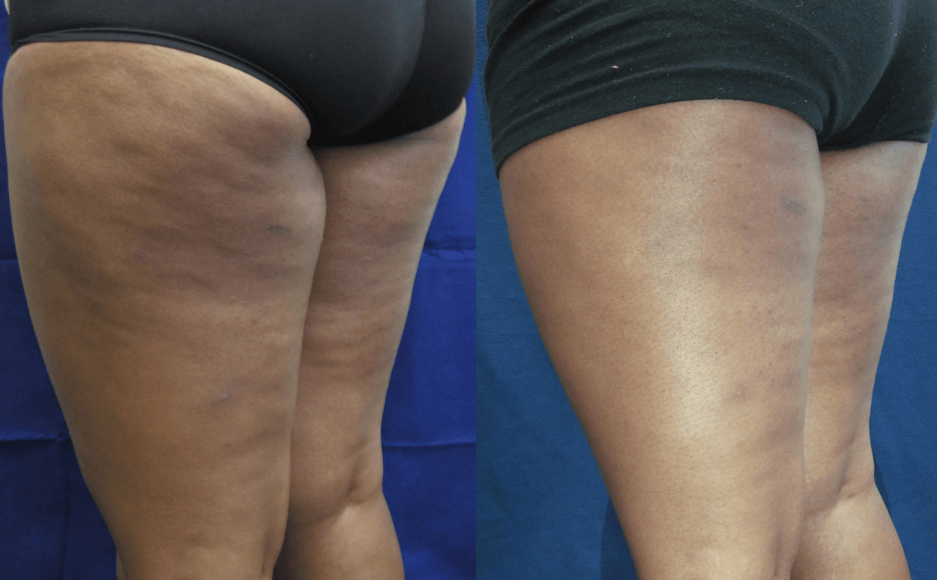 Body FX laser fat reduction
