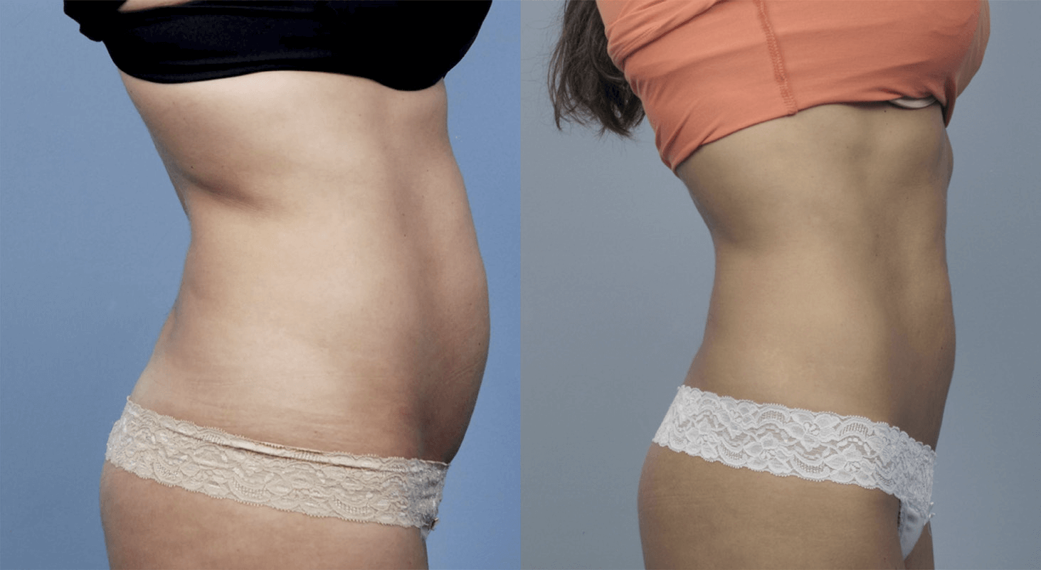 Body FX laser fat reduction