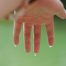 A wet hand due to hyperhidrosis
