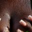 A woman's chest covered in sweat wondering what are the best hyperhidrosis treatments
